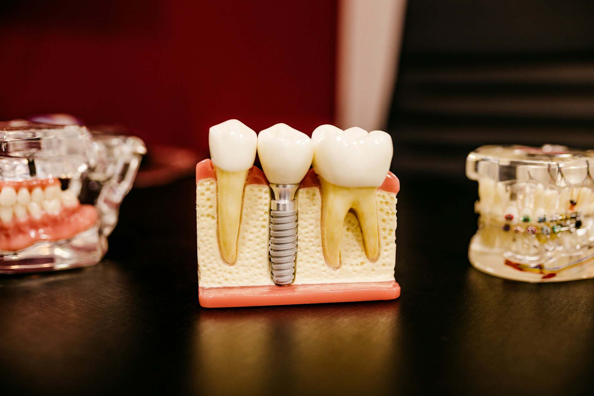 Modelo de arcada com implantes e coroas sobre mesa escura